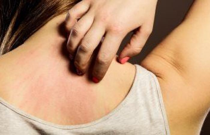 مرضى كورونا الذين يعانون من أعراض طويلة قد يعانون أيضا من مشاكل جلدية