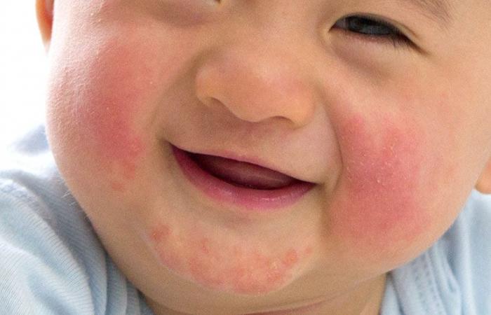 5 أنواع من الطفح الجلدى قد تنتقل لطفلك بالعدوى