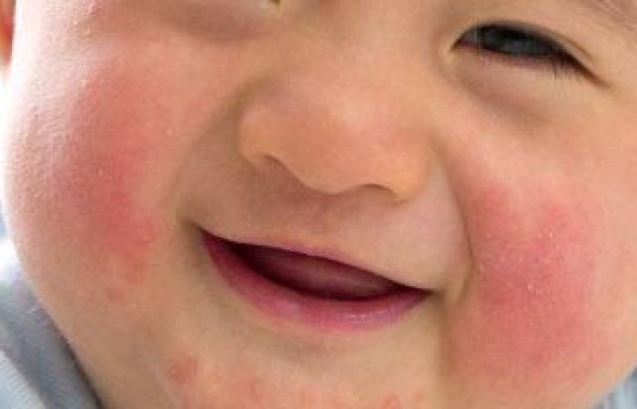 5 أنواع من الطفح الجلدى قد تنتقل لطفلك بالعدوى