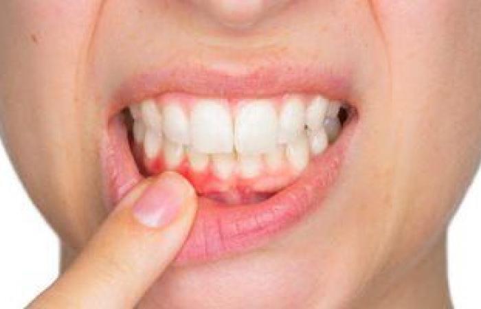 علاج نزيف اللثة المتكرر.. نظافة الفم المفتاح الأساسى للتغلب على البكتيريا