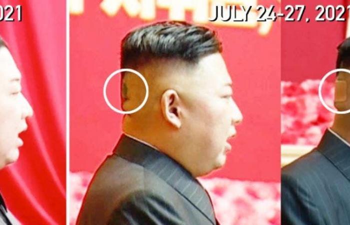 كدمة وضمادة.. رأس زعيم كوريا الشمالية يثير الحيرة!