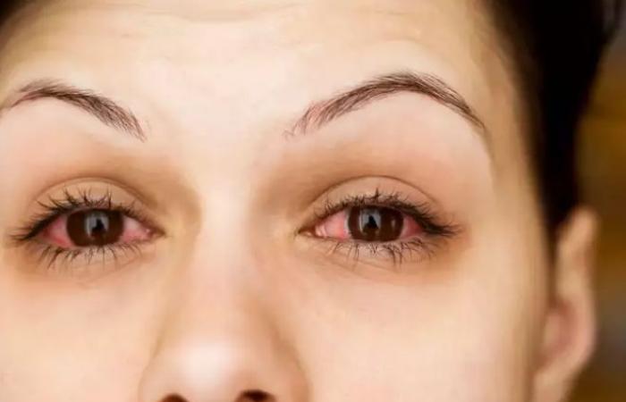 ما هو إجهاد العين وأعراضه وطرق الوقاية منه؟