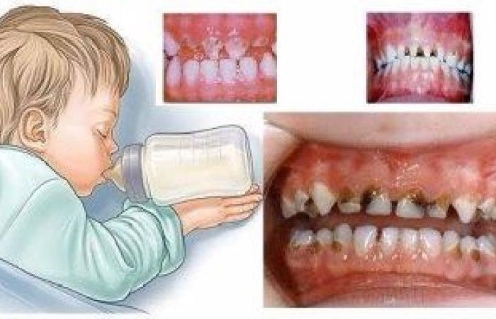 أسباب تسوس الأسنان لدى الأطفال وطرق الوقاية