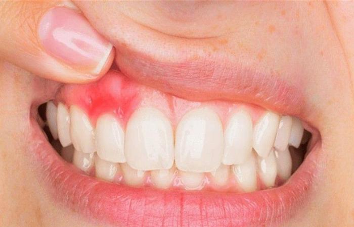 هل تعانون من التهابات الفم؟... اليكم هذه المعلومات