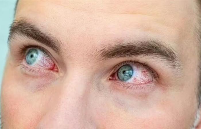 كيف تكشف العينان عن الإصابة بالتهاب المفاصل؟