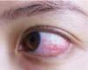 دراسة تؤكد ضرورة فحوصات العين لمرضى كورونا لعلاج التشوهات المحتملة