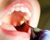 علاج التهاب اللثة.. احرص على نظافة الفم وأقلع عن التدخين