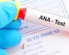 تحليل الأجسام المضادة للنواة ANA وأهميته في اكتشاف الأمراض