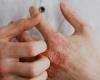 5 أنواع للالتهابات الفطرية.. أبرزها السعفة وعدوى الأظافر