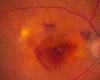 ما هو مرض تلف شبكية العين وأسباب الإصابة به؟ تقرير يوضح
