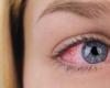 8 نصائح لمنع التهابات العيون والحساسية الموسمية