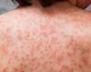 كيف يمكن أن يؤثر التهاب الكبد الوبائى سى على الجلد؟