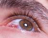 5 أسباب لاحمرار العيون.. منها كورونا