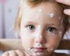 علاج الطفح الجلدى عند الأطفال بعلاجات منزلية.. اعرف التفاصيل