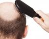 تقنية جديدة لمستقبل علاجات تساقط الشعر