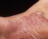 الأمراض الجلدية الأكثر شيوعاً...الأسباب والعلاج