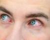 كيف تكشف العينان عن الإصابة بالتهاب المفاصل؟